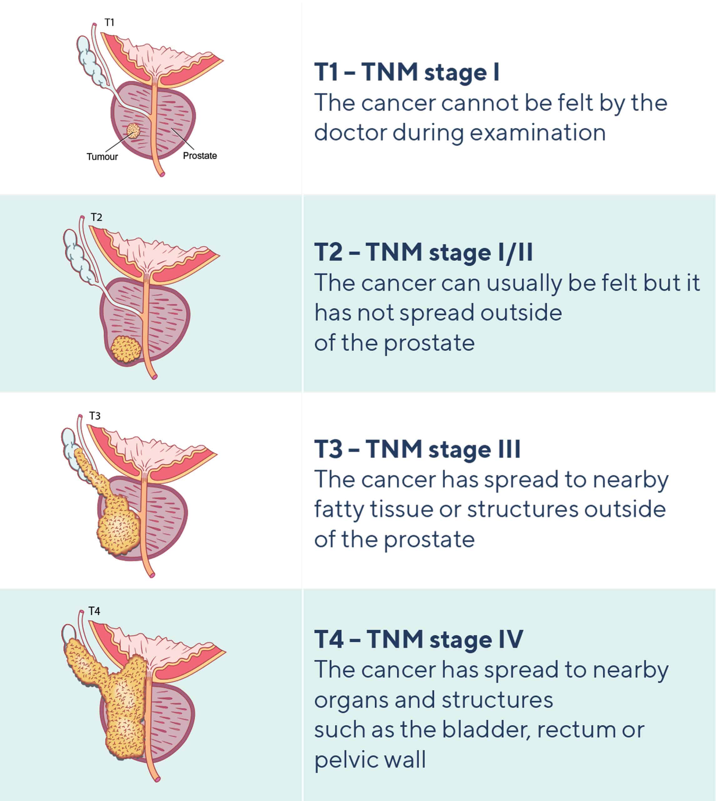 Prostate Cancer Stage 1 Prostate Cancer Advanced Symptoms 