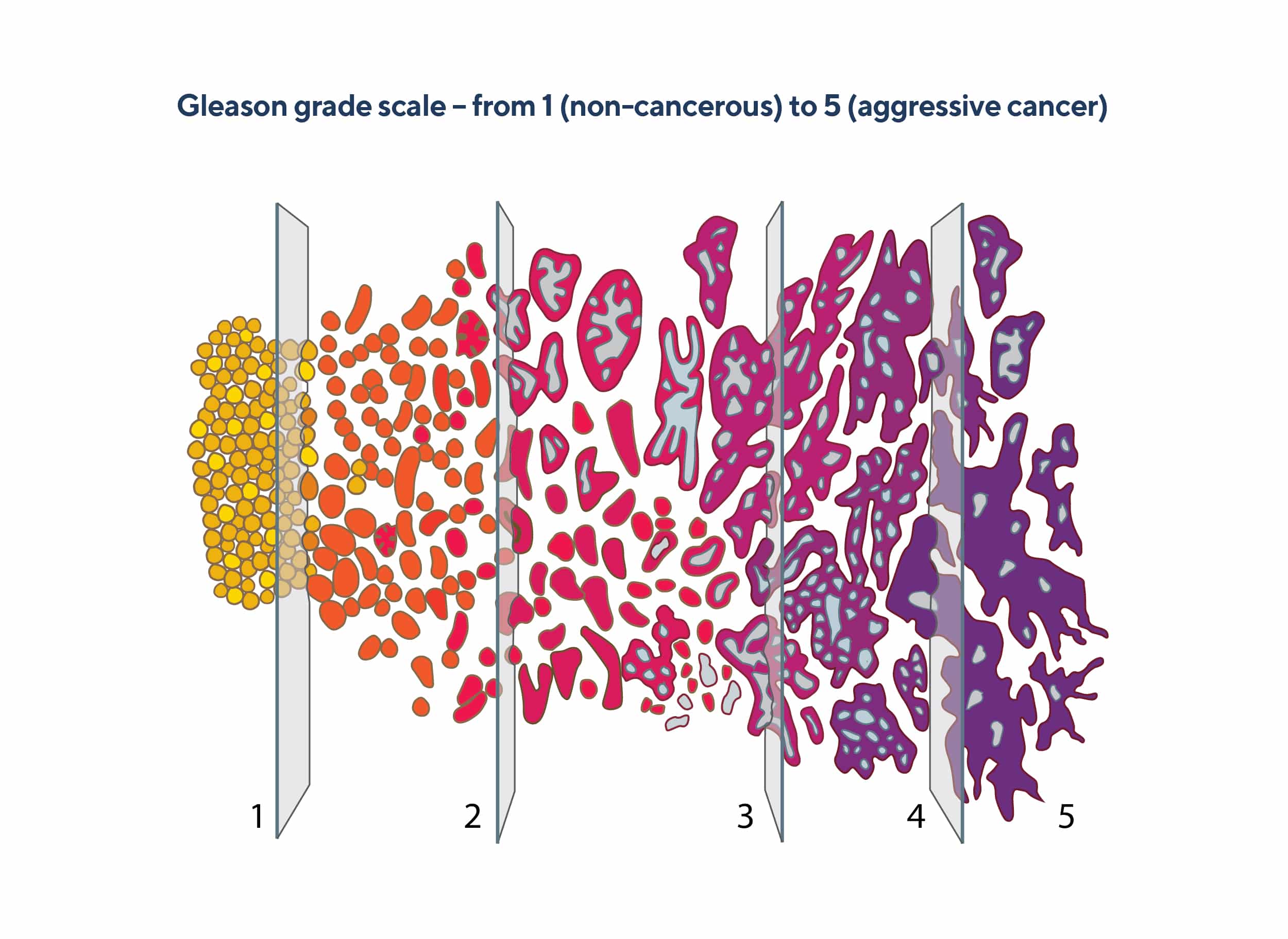 2.12b – Gleason pattern