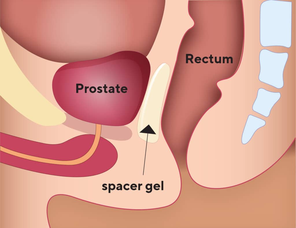 Radiation Therapy 2 3.4b – rectum spacers