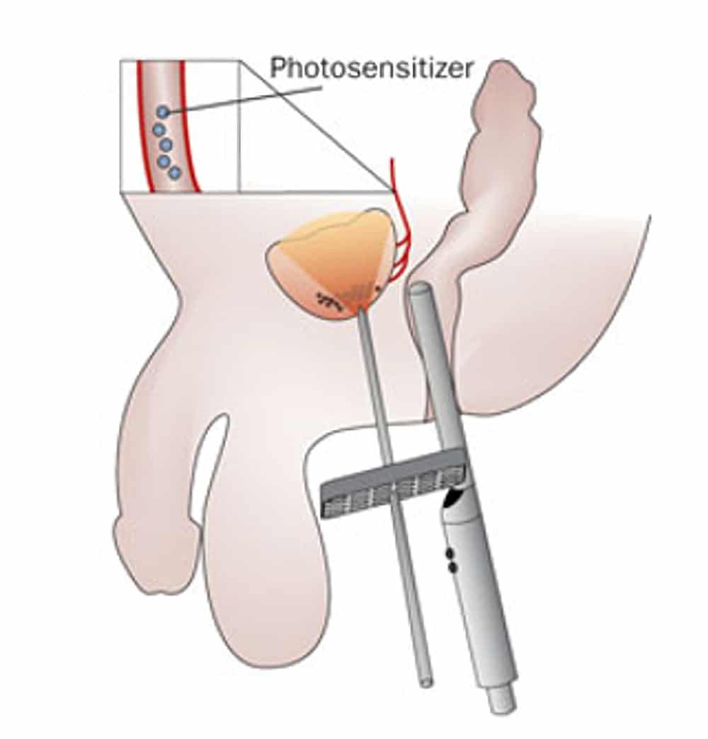 3.5d – photodynamic therapy