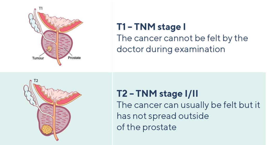 Localised cancer: TNM stages I or II