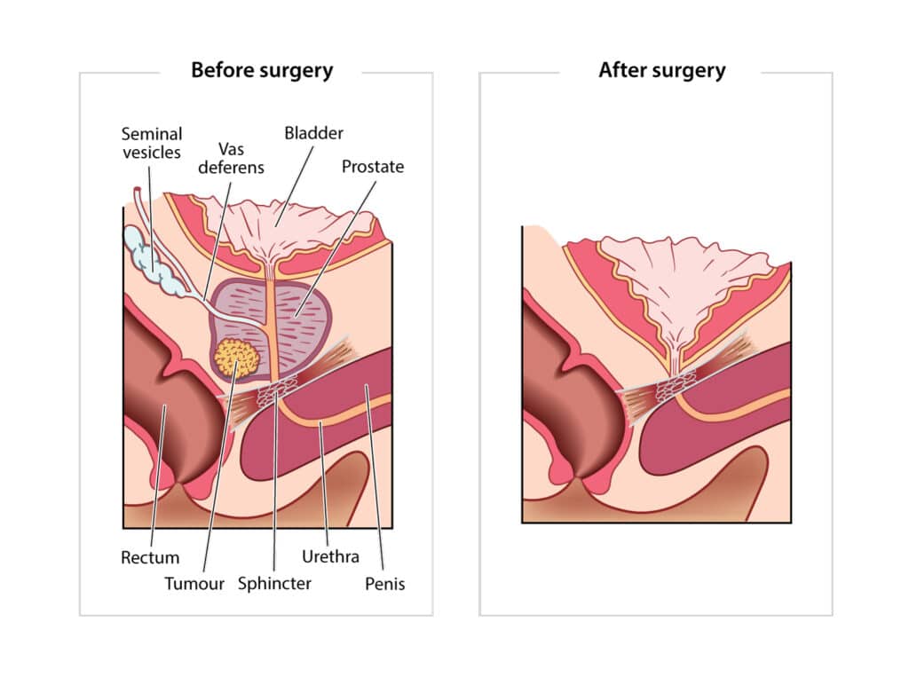 Diagram of the before and after of prostate cancer surgery.