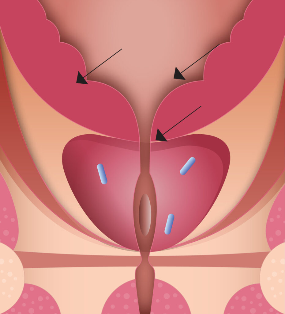 Radiation Therapy 1 Diagram of three Fiducial marker seeds in the prostate,